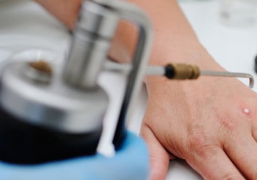 Faster Recovery Tips Inside! Stages of Wart Healing After Freezing Guide